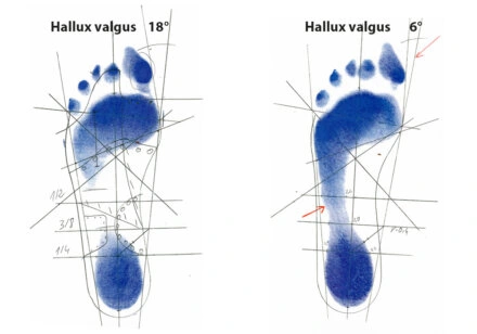 Korrekturbeispiel 2 Hallux valgus