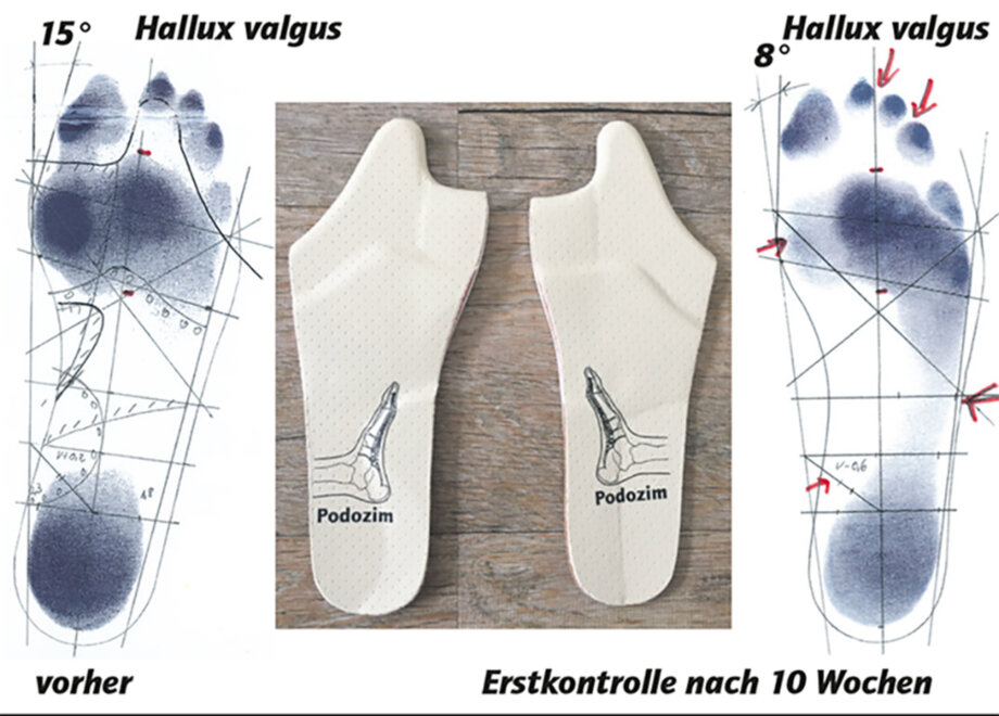 Hallux valgus - messbare Behandlungserfolge